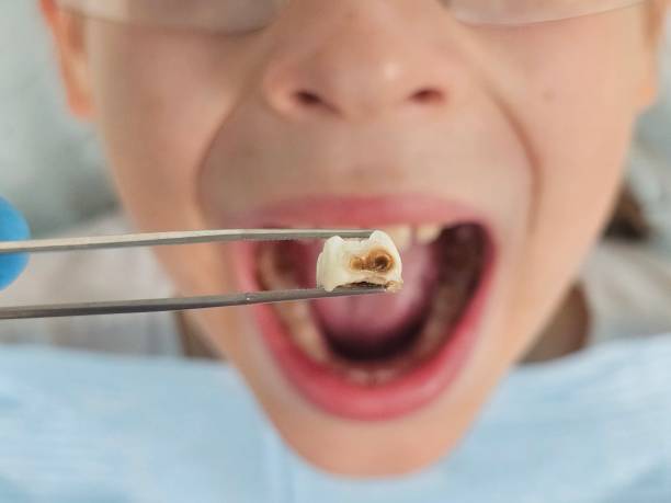 Best Dentist for Tooth Abscess  in Lincolndale, NY